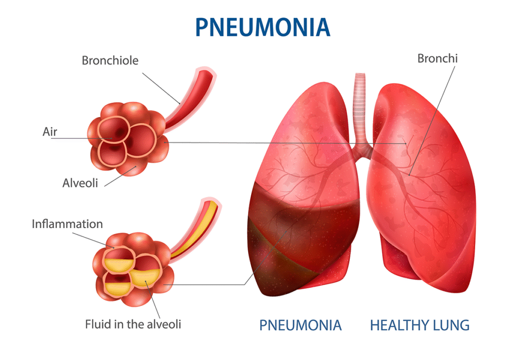 Pneumonia Warning Signs: 7 Symptoms You Should Never Ignore