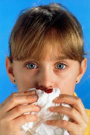 First aid steps for nosebleeds