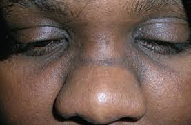 allergic salute A person using a saline rinse as a treatment for rhinitis.