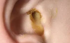 download A medical diagram showing the causes and symptoms of otorrhea (ear discharge).