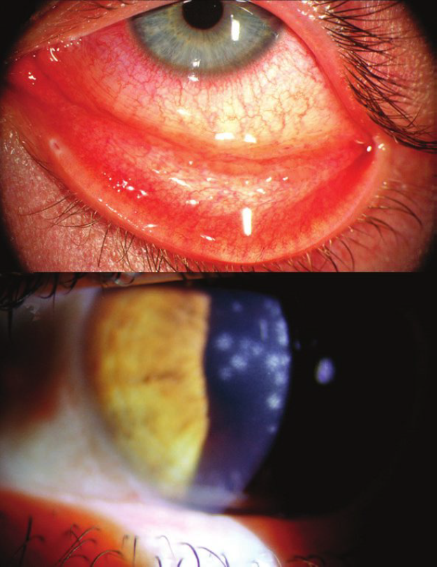 An educational diagram showing the location of the conjunctiva, which becomes inflamed during conjunctivitis (pink eye)