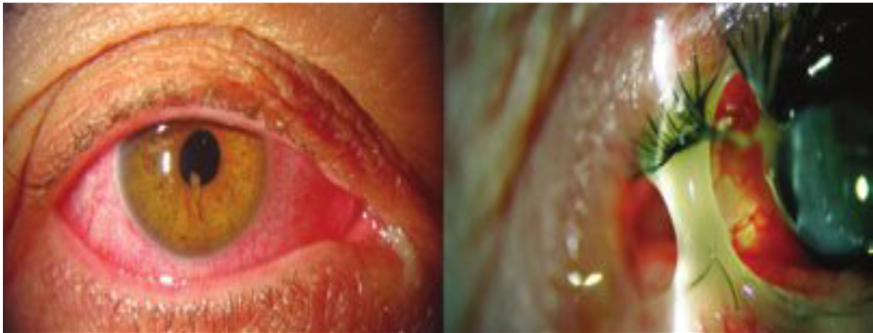 An educational diagram showing the location of the conjunctiva, which becomes inflamed during conjunctivitis (pink eye)