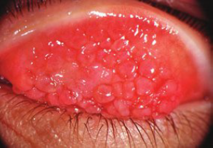 An educational diagram showing the location of the conjunctiva, which becomes inflamed during conjunctivitis (pink eye)