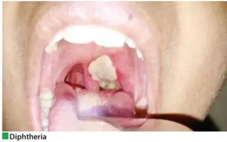 Home remedies for treating throat infections, including honey, lemon, salt water gargles, and a humidifier.