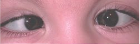 An educational diagram showing the different types of eye misalignment caused by strabismus.