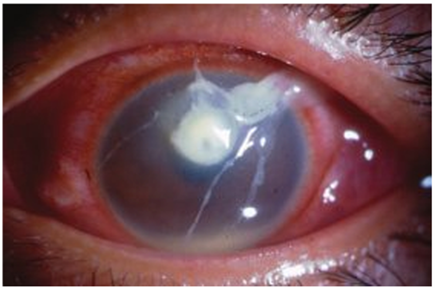 A diagram showing the location of a corneal ulcer as a white spot on the eye's cornea.