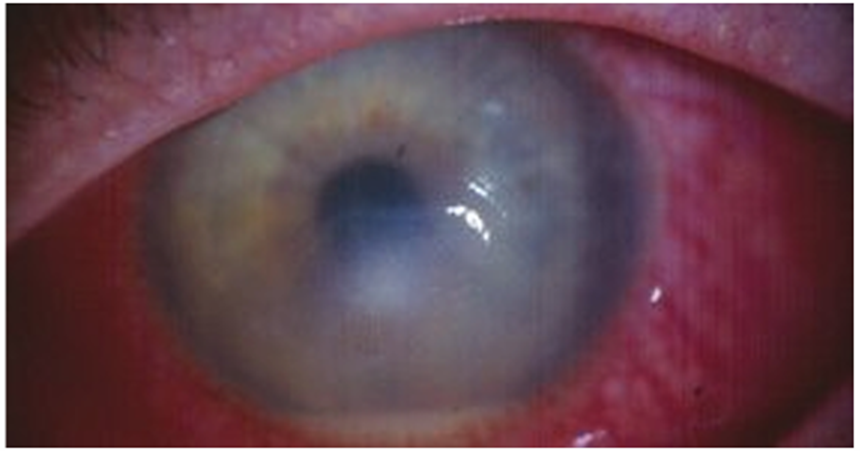 A diagram showing the location of a corneal ulcer as a white spot on the eye's cornea.