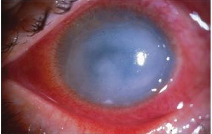 A diagram showing the location of a corneal ulcer as a white spot on the eye's cornea.