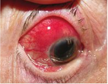  A medical diagram comparing a normal eye to an eye with the severe redness of scleritis.