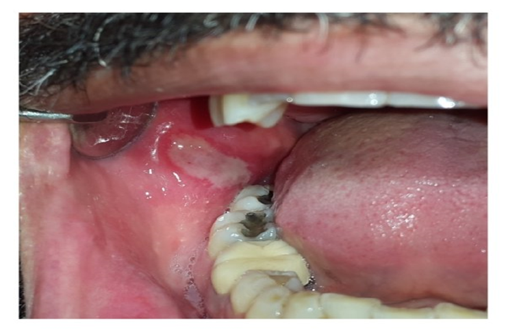 A diagram showing a common oral ulcer (canker sore) inside the mouth.