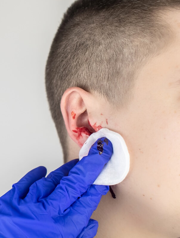 Illustration showing the causes of bleeding from the ear, including a ruptured eardrum and infection inside the ear canal.
